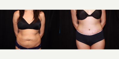 Case 2348 - Tummy Tuck - Abdominoplasty