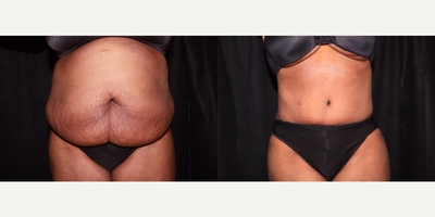 Case 2349 - Tummy Tuck - Abdominoplasty