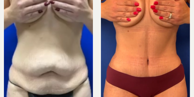 Case 235 - Woman treated with Tummy Tuck