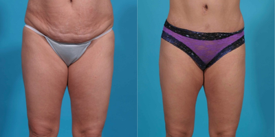 Case 2350 - 35-44 year old woman treated with Tummy Tuck