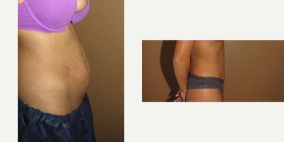 Case 2351 - 18-24 year old woman treated with Tummy Tuck