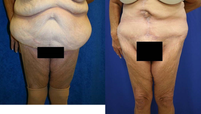Case 2352 - Tummy Tuck