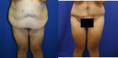 Case 2353 - Tummy Tuck
