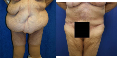 Case 2354 - Tummy Tuck