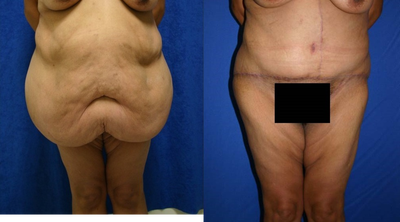 Case 2355 - Tummy Tuck