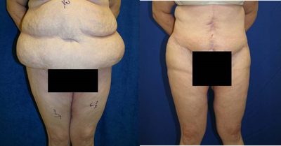 Case 2356 - Tummy Tuck