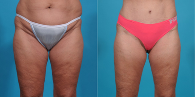 Case 2357 - 45-54 year old woman treated with Tummy Tuck