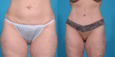 Case 2358 - 45-54 year old woman treated with Tummy Tuck