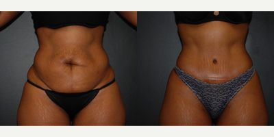 Case 2359 - 35-44 year old woman treated with Tummy Tuck