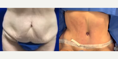Case 236 - Woman treated with Tummy Tuck