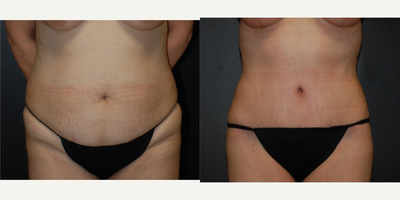 Case 2360 - 45-54 year old woman treated with Tummy Tuck