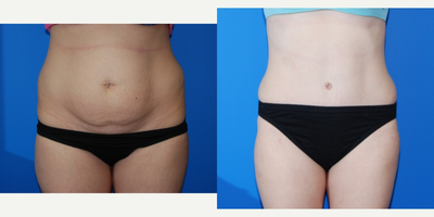 Case 2361 - 35-44 year old woman treated with Tummy Tuck