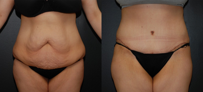 Case 2362 - 45-54 year old woman treated with Tummy Tuck