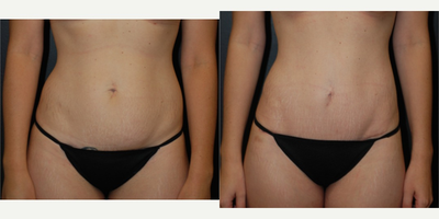 Case 2363 - 25-34 year old woman treated with Tummy Tuck