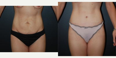Case 2364 - 35-44 year old woman treated with Tummy Tuck