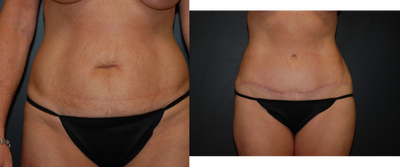 Case 2365 - 35-44 year old woman treated with Tummy Tuck