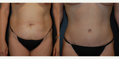 Case 2366 - 25-34 year old woman treated with  Tummy Tuck