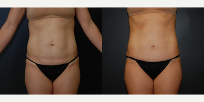 Case 2367 - 35-44 year old woman treated with Tummy Tuck