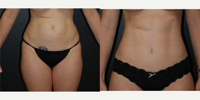 Case 2368 - 35-44 year old woman treated with Tummy Tuck