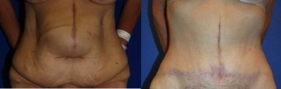 Case 2369 - Tummy Tuck
