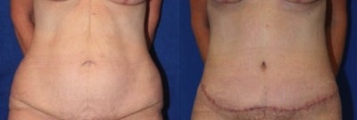 Case 2370 - Tummy Tuck