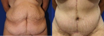 Case 2371 - Tummy Tuck