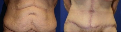 Case 2373 - Tummy Tuck