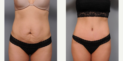 Case 2374 - 38 year old woman treated with Mommy Makeover