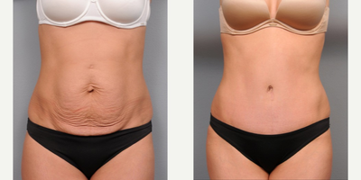 Case 2375 - 36 year old woman treated with Tummy Tuck and Hernia Repair