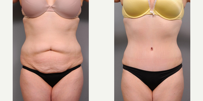 Case 2376 - Tummy Tuck with Flank Liposuction
