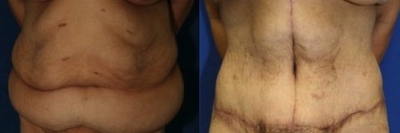 Case 2377 - Tummy Tuck