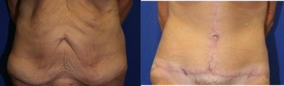 Case 2378 - Tummy Tuck