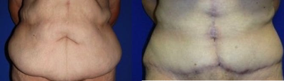 Case 2379 - Tummy Tuck