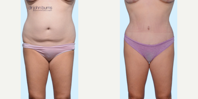 Case 238 - Woman treated with Tummy Tuck