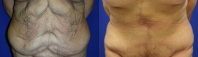 Case 2380 - Tummy Tuck