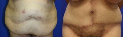 Case 2381 - Tummy Tuck
