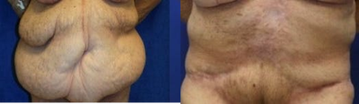 Case 2382 - Tummy Tuck