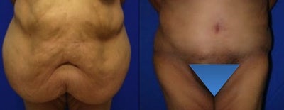 Case 2383 - Tummy Tuck