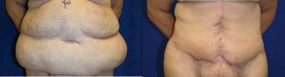 Case 2384 - Tummy Tuck