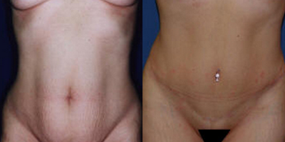 Case 2385 - 45-54 year old woman treated with Tummy Tuck
