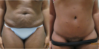 Case 2386 - 25-34 year old woman treated with Tummy Tuck