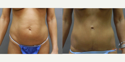 Case 2387 - 35-44 year old woman treated with Tummy Tuck