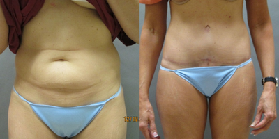 Case 2388 - 45-54 year old woman treated with Tummy Tuck