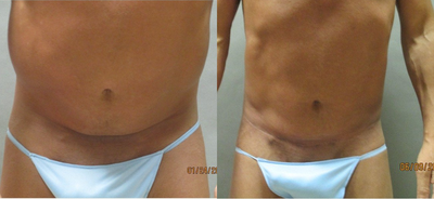 Case 2389 - 35-44 year old man treated with Tummy Tuck