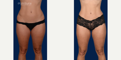 Case 239 - Woman treated with Tummy Tuck