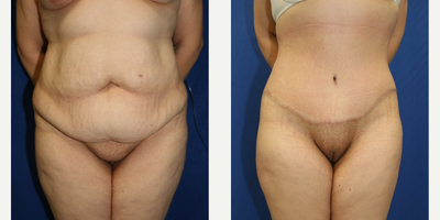 Case 24 - Woman treated with Tummy Tuck