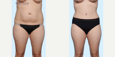 Case 240 - Woman treated with Tummy Tuck