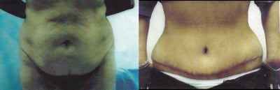 Case 2406 - 54 Year Old Female - Abdominoplasty