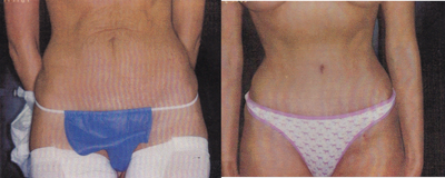 Case 2407 - 32 Year Old Female - Mommy Makeover