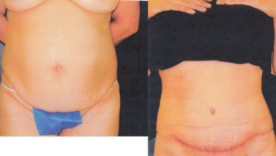 Case 2408 - 42 Year Old Female - Abdominoplasty